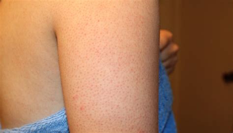 This is the reason you're getting red bumps on your arms | smooth