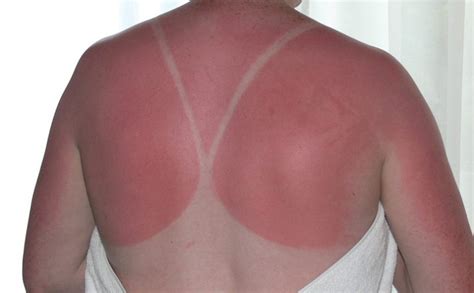 Sunburn Aftercare Tips & Treatments | Greg Keily Chemist, Southport