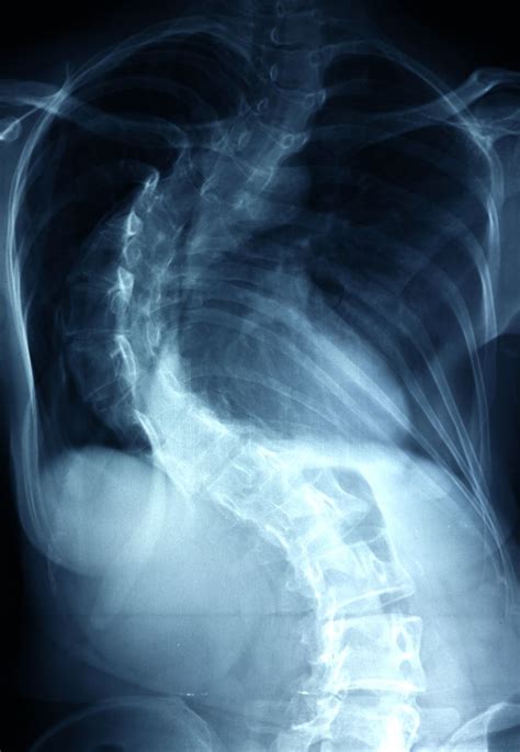 Levoskoliose und Dextroskoliose Skoliose Wegbeschreibung