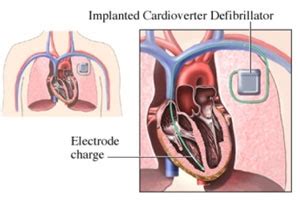 AICD Surgery Cost India|Implantable Cardioverter-Defibrillator (ICD) in India