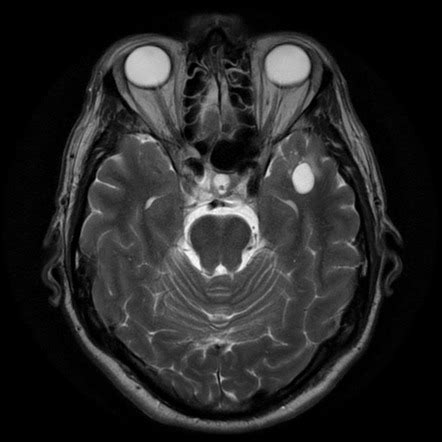 Anterior temporal lobe perivascular spaces | Radiology Reference ...