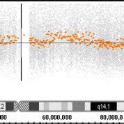 Deletion in 11q25 shown in Affymetrix human SNP array 6.0. Affymetrix ...