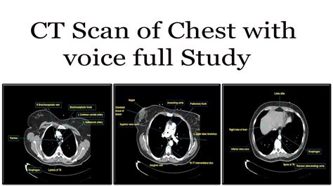 CT Scan of chest with contrast full axial view study with voice - YouTube