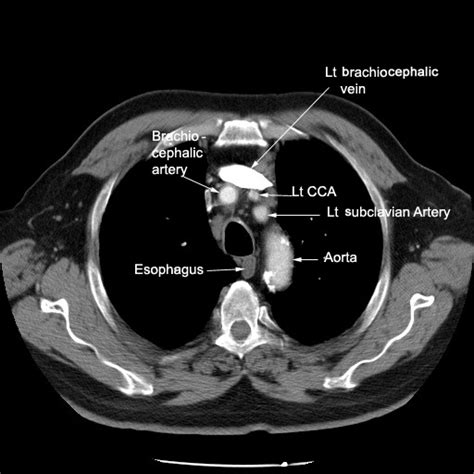 Aortic Arch Ct Scan | My XXX Hot Girl