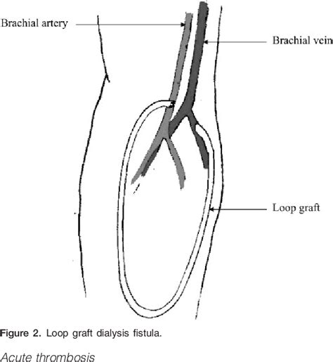 Figure 2 from Ultrasound of Haemodialysis Radiocephalic Fistula: A Pictorial Essay | Semantic ...