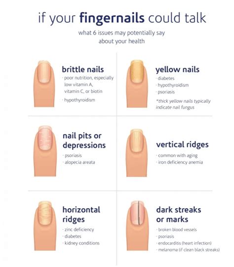 What Deficiency Causes Vertical Lines On Nails - Design Talk