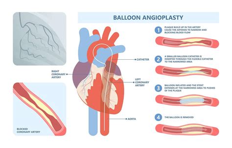 difference between angiography and angioplasty | Dr Raghu