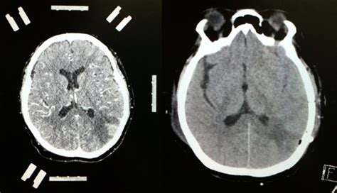 Contrast-enhanced CT scan of the left side of the brain showing... | Download Scientific Diagram