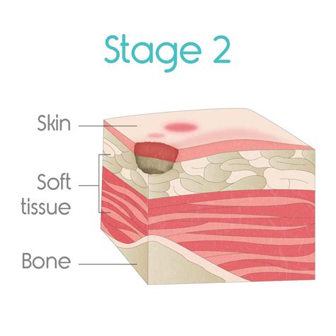 stage two bed sores | Bed sores, Soreness, Brain injury