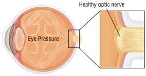 Optic Nerve Swelling (Papilledema) - Harvard Health