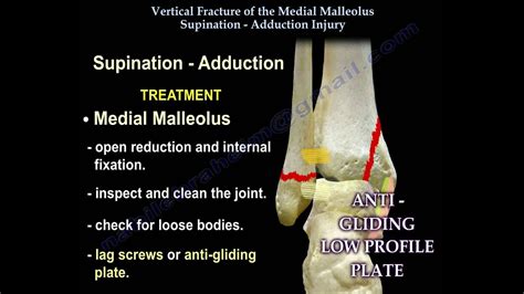 Vertical Fracture Of The Medial Malleolus - Everything You Need To Know - Dr. Nabil Ebraheim ...