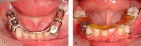 [PDF] Modified Distal Shoe Appliance for Bilateral Early Loss of Primary Molars: Report of Four ...