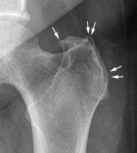 Are Radiographic Trochanteric Surface Irregularities Associated with ...