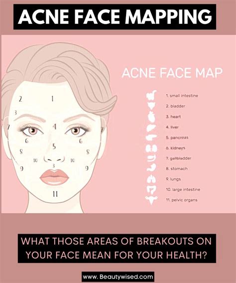 Acne face map: What does acne pimples on your cheeks, forehead, jawline ...