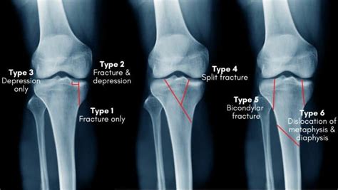 Tibial Plateau Fracture Brace | Best Brace Tibial Plateau Fracture