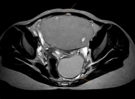 Bilateral Chocolate Cysts-MRI - Sumer's Radiology Blog