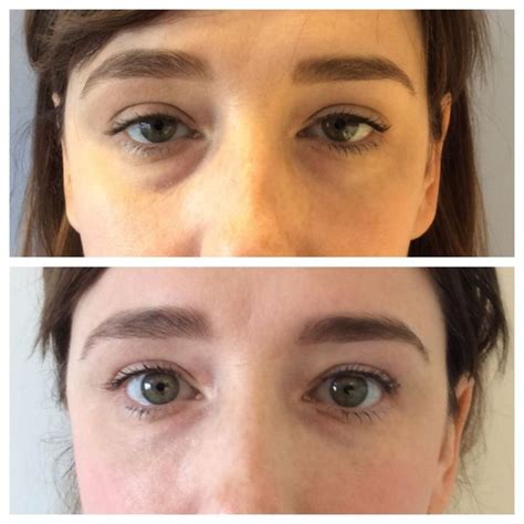 Another great before/after of non-surgical under eye injections! | Gold wedding jewelry ...