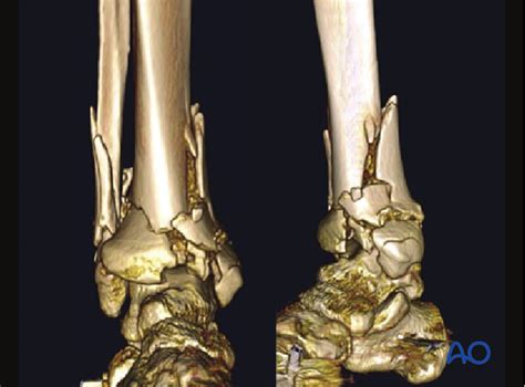 Anteromedial approach to the distal tibia