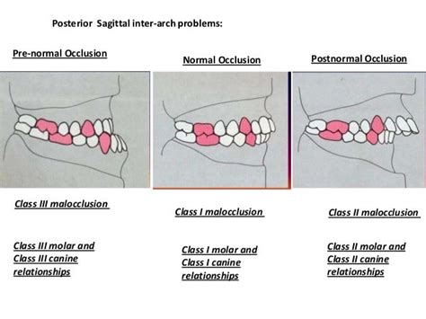 Classification of Occlusion and Malocclusion Dr. Nabil Al-Zubair