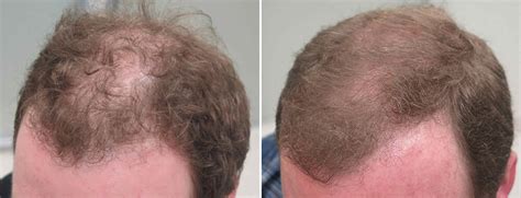 Finasteride Before and After Photos [2023]