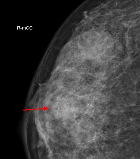 Fibroadenoma - Causes, Symptoms, Diagnosis, Treatment