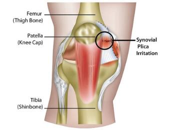 Plica Syndrome - Motion Health Centre