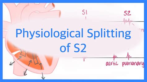 Physiological Splitting of S2 - YouTube