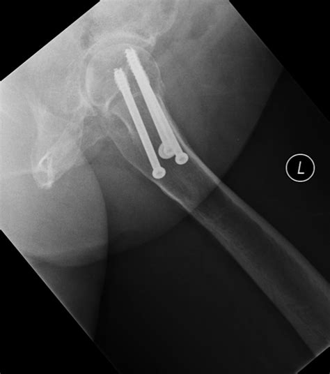 Neck of Femur Fracture - Subcapital - Intertrochanteric - TeachMeSurgery