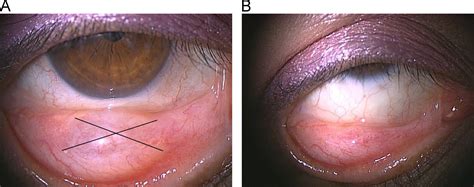 Clinical evaluation of a novel surgical technique (large cross incision ...