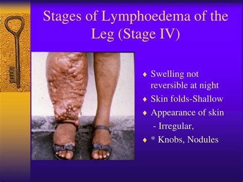 PPT - Lymphatic Filariasis PowerPoint Presentation - ID:145597