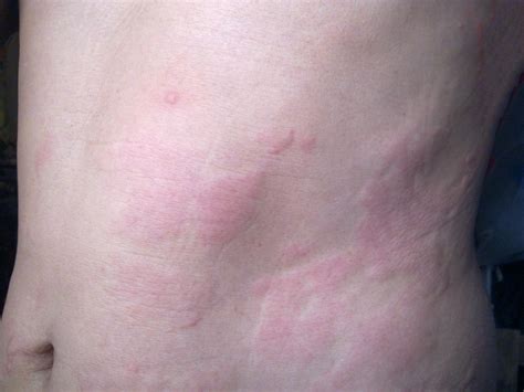 Got hives? Hold the steroids | EurekAlert!