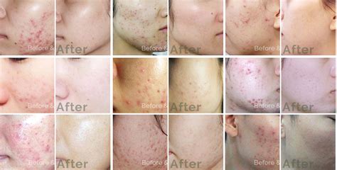 No.1 Acne Removal Treatment in Singapore. Best Acne Treatment To Get ...