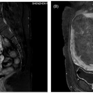 Contrast MRI obtained from a 41-year-old patient with adenomyosis who ...