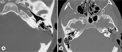 (Patient 3) Axial CT scans. A) Preoperative scan shows cholesteatoma... | Download Scientific ...