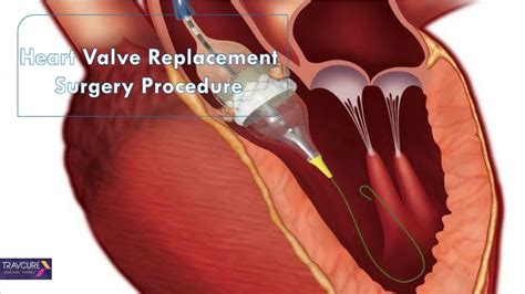 PPT - Heart Valve Replacement Surgery Procedure PowerPoint Presentation ...