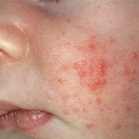 scabies on the face - pictures, photos