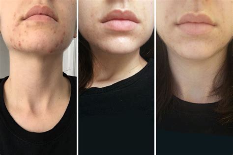 Spironolactone for Acne Before-and-After Photos