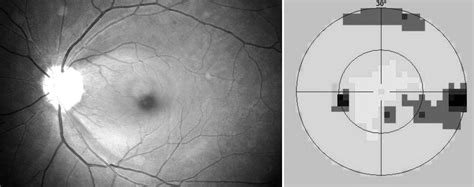 Nerve Fiber Layer Defects Imaging in Glaucoma | IntechOpen