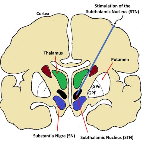 Cureus | Deep Brain Stimulation and Microelectrode Recording for the ...