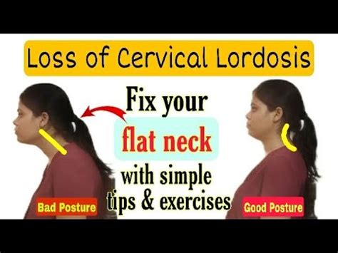 4 Best Posture Correction Exercises | How to restore neck curve - YouTube