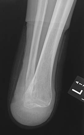 Syme amputation | Radiology Case | Radiopaedia.org