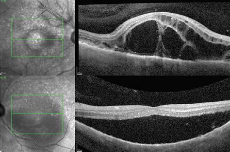 Serous Retinal Detachment Oct