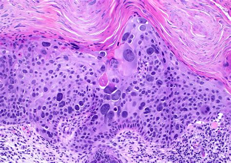 Squamous cell carcinoma in situ (Bowen's disease) with massive pleomorphism and eyeliner sign ...