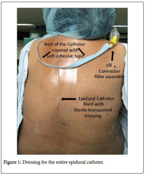 anesthesia-clinical-research-epidural-catheter