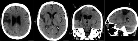 Radiology MRI: Wallerian Degeneration