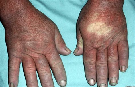 Scleroderma - Causes, Symptoms, Prognosis, Diagnosis, Treatment