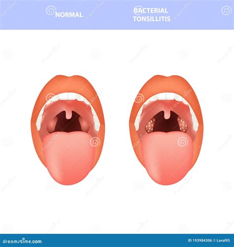 Open Mouth, Normal and Tonsillitis Bacterial and Viral. Angina, Pharyngitis and Tonsillitis ...