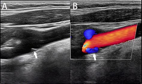 Frontiers | The carotid web: Current research status and imaging features