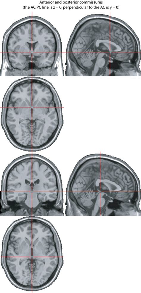 Where is the anterior commissure? - FieldTrip toolbox