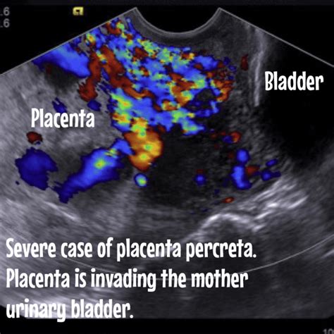 Everything about the placenta. Ultrasound images included ...